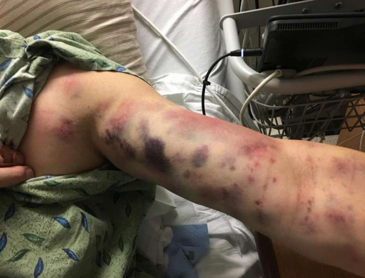 男子倒完垃圾「手臂一塊塊開始腐爛」！麻痺送醫才發現....竟是「被牠咬了一小口」妻子當場崩潰！