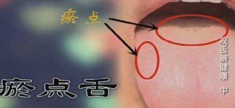 從舌頭一眼看是否癌症體質，癌細胞最怕1種鹼性食物，常吃防癌