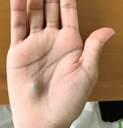 他看完牙醫「手上長出藍色小球」，體重「6周掉12公斤」醫生嚇傻：晚一步就死定了！