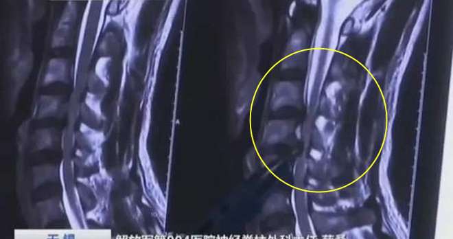 致命壞習慣⚡！每天躺沙發上玩手機，男子突然呼吸困難，39歲就『脊髓偏癱瘓』！?