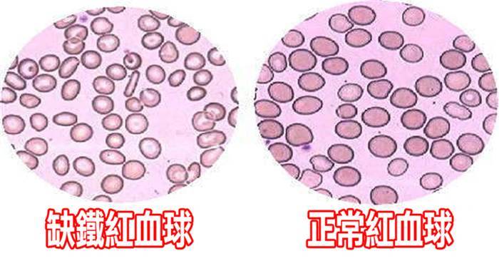 他一入夜就感覺雙腿有「螞蟻在爬蟲子在咬」無法安穩入睡，誰也沒想到這竟是「帕金森」的前兆！