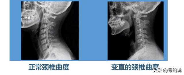 頸椎病5個鍛煉動作詳解，超簡單！每次3分鐘，拯救生命線