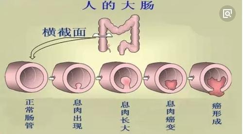 胃腸道「息肉」是什麼？醫生：息肉是癌的近親，要引起注意
