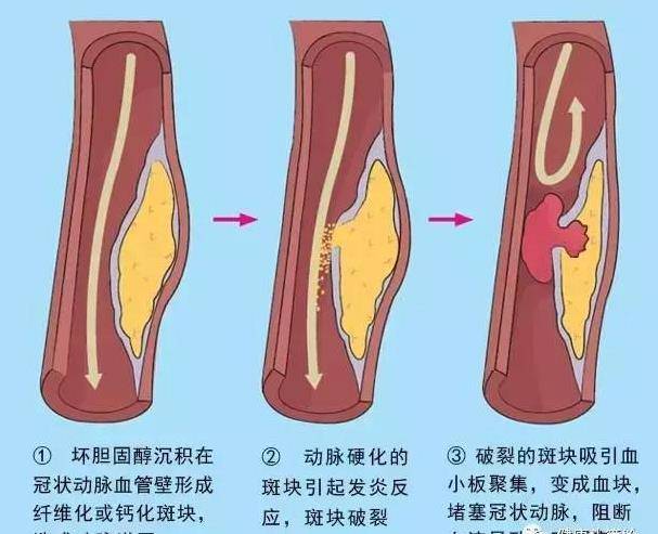 心肌梗塞急救法（黃金10秒），關鍵時刻，能救自己一命，珍重生命，請大家告訴身邊的朋友吧！