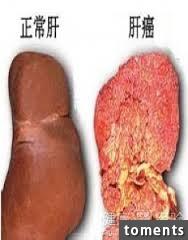 他的「右肩時常酸痛」結果竟是「肝癌」引起，發現時已經末期無法救回！有這5種症狀趕快去檢查！！