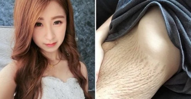 21歲辣媽生四胞胎「驚見肚皮裂開」被酸很噁心！她PO比基尼照怒轟：「尊重全世界的女性！」
