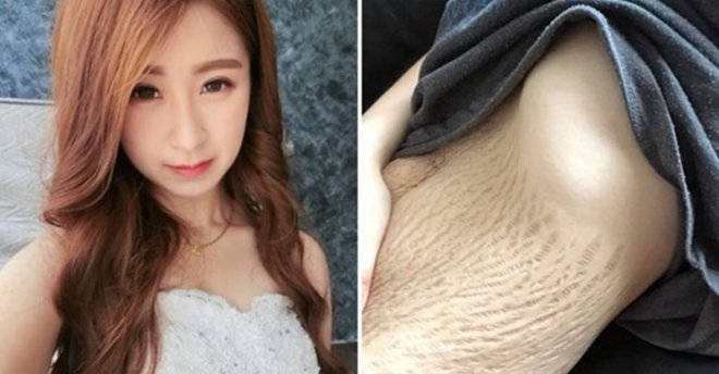 21歲辣媽生四胞胎「驚見肚皮裂開」被酸很噁心！她PO比基尼照怒轟：「尊重全世界的女性！」