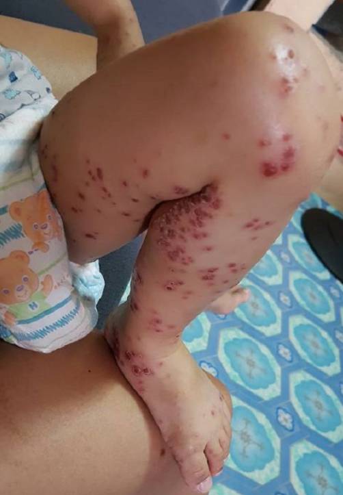 兒子從賣場回家「皮膚紅腫潰爛」！醫生檢查嘆「沒藥可醫」媽媽痛心呼籲：所有家長都要注意