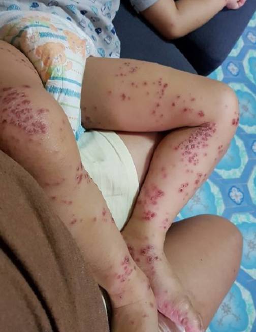 兒子從賣場回家「皮膚紅腫潰爛」！醫生檢查嘆「沒藥可醫」媽媽痛心呼籲：所有家長都要注意