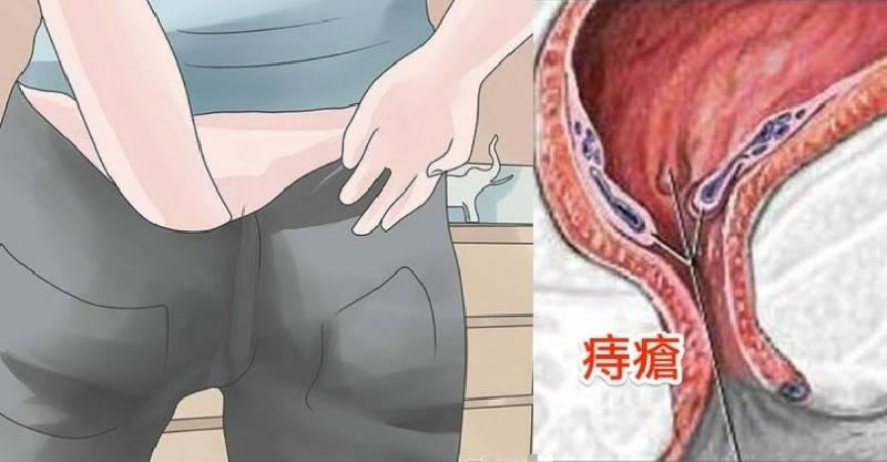 教你兩種方法自然根除「痔瘡」，人人都不再癢只要簡單幾分鐘