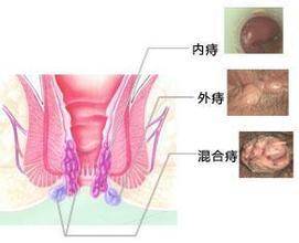 教你兩種方法自然根除「痔瘡」，人人都不再癢只要簡單幾分鐘