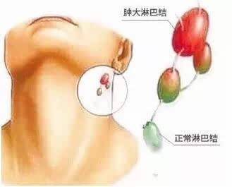 注意了！「脖子長小肉粒」是怎麼回事？他們在警示你，你的身體已出問題！
