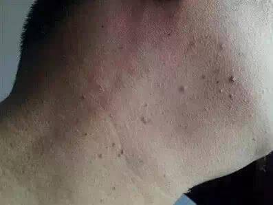 注意了！「脖子長小肉粒」是怎麼回事？他們在警示你，你的身體已出問題！