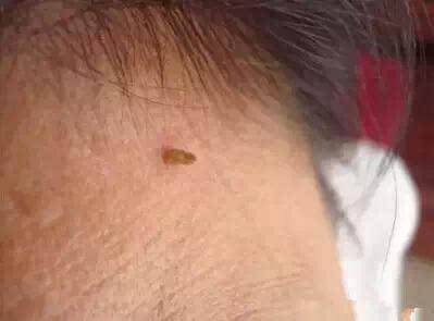 注意了！「脖子長小肉粒」是怎麼回事？他們在警示你，你的身體已出問題！