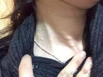 注意了！「脖子長小肉粒」是怎麼回事？他們在警示你，你的身體已出問題！