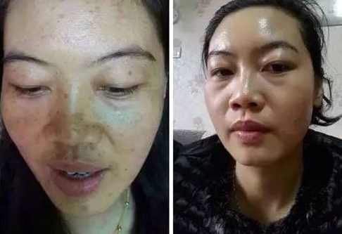 半根黃瓜祛斑法，36歲大姐5天淡斑，一周蛻變水潤豆腐肌！