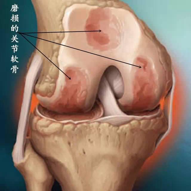 膝蓋疼痛難忍？59歲阿麼用了7天，緩解了膝蓋疼痛，膽固醇和高血壓也降了很多，為爸媽收好！