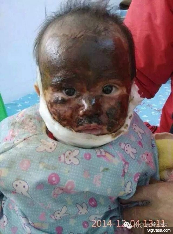 1歲小孩的臉被燙傷，一種「神奇的植物果實」救了孩子！知道了一定要分享！