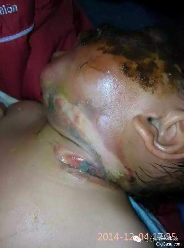 1歲小孩的臉被燙傷，一種「神奇的植物果實」救了孩子！知道了一定要分享！