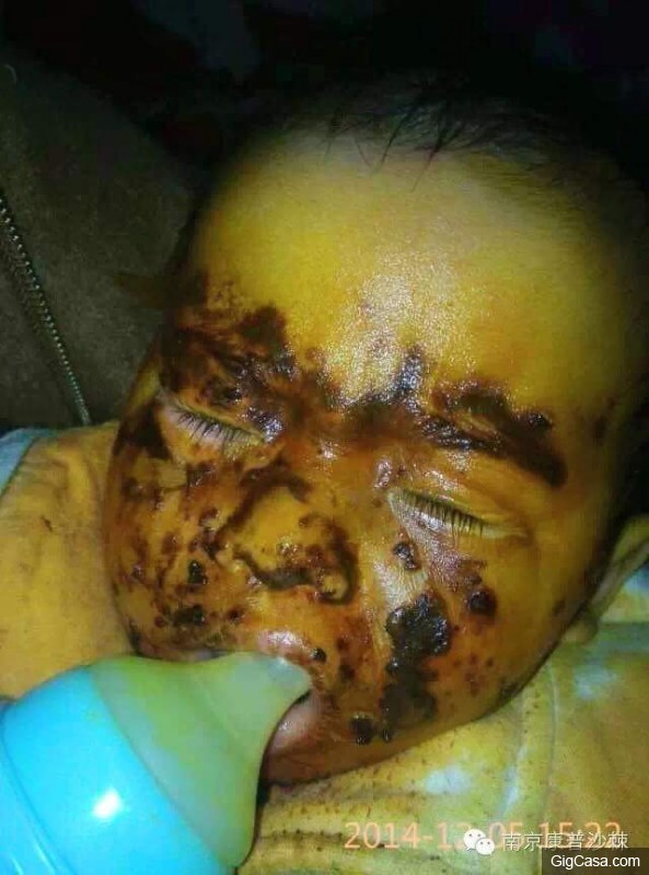 1歲小孩的臉被燙傷，一種「神奇的植物果實」救了孩子！知道了一定要分享！