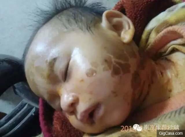 1歲小孩的臉被燙傷，一種「神奇的植物果實」救了孩子！知道了一定要分享！