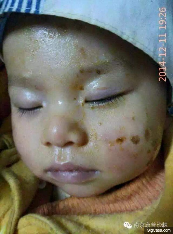 1歲小孩的臉被燙傷，一種「神奇的植物果實」救了孩子！知道了一定要分享！