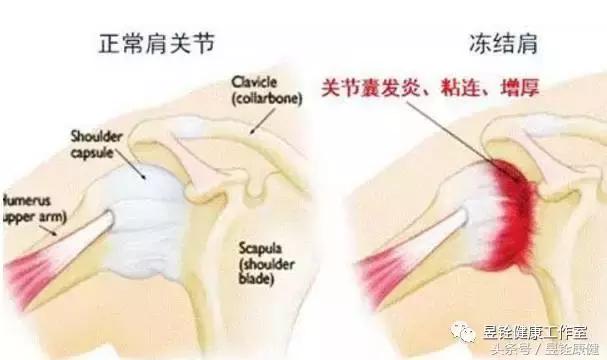 原來！「肩周炎」是這樣引起的....多注意這些就能「緩解症狀」！