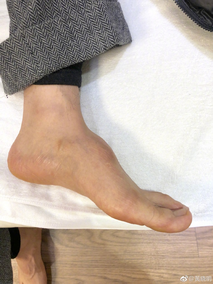 心疼！黃曉明被疑增高鞋墊疊過高, 脫下鞋子露出「畸形腳型」後, 剛剛笑他的粉絲都後悔了！