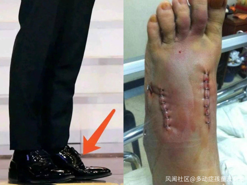心疼！黃曉明被疑增高鞋墊疊過高, 脫下鞋子露出「畸形腳型」後, 剛剛笑他的粉絲都後悔了！