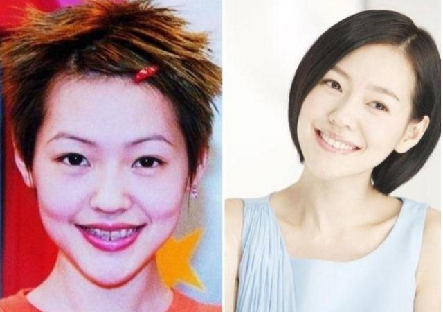 明星矯牙前：林心如又土又村，高圓圓不敢張嘴笑，baby簡直換張臉 
