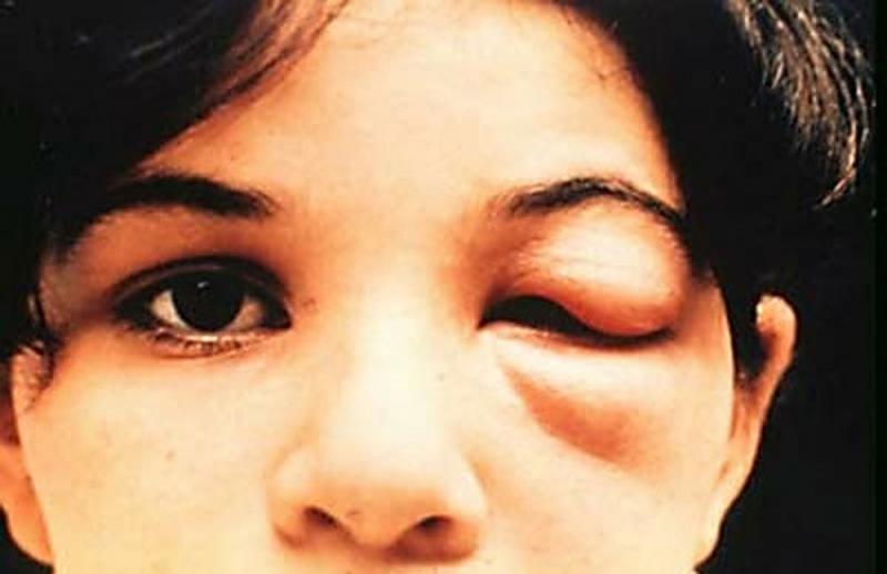 如果你在家中看到這種蟲子請「立刻去醫院看診」，因為「一點都不會有症狀」你會比死還痛苦！