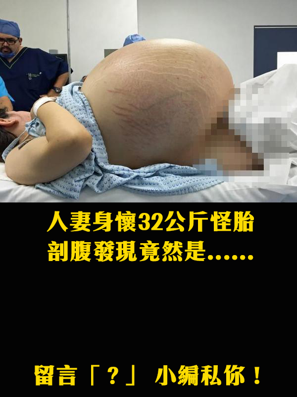 【爆趣】新婚人妻身懷32公斤「怪胎」？手術取出的東西嚇壞了所有醫生...
