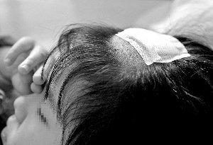女兒頭痛險沒命！老師撥開頭髮發現「髮尖在動」愣住 園長看了1眼馬上送醫：差點保不住 