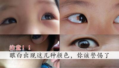眼白出現這幾種顏色 你該警惕了幫家人也看一看