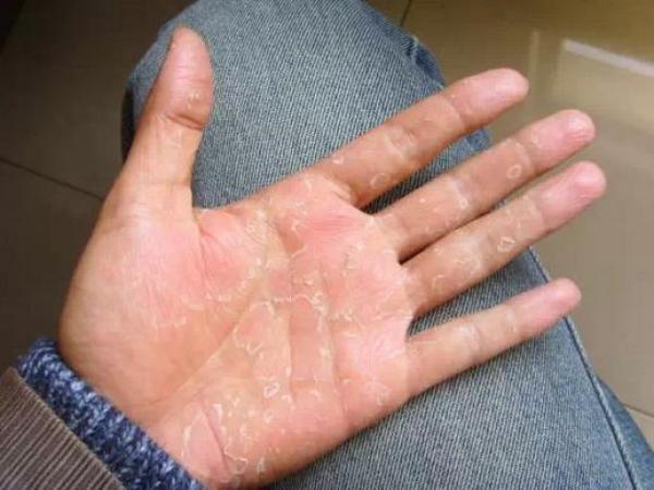 送給大家一個偏方：手脫皮、腳跟痛、手腳抽筋、腳雞眼、手腳皸裂治療！這些方法居然都可以在家自己來！