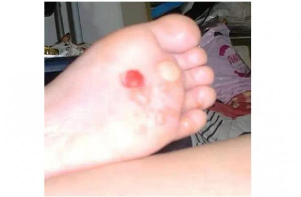 送給大家一個偏方：手脫皮、腳跟痛、手腳抽筋、腳雞眼、手腳皸裂治療！這些方法居然都可以在家自己來！