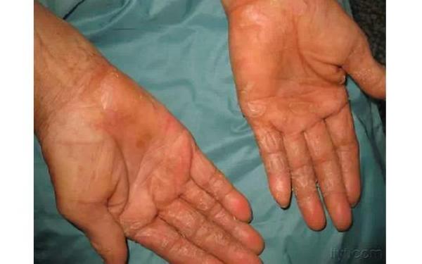 送給大家一個偏方：手脫皮、腳跟痛、手腳抽筋、腳雞眼、手腳皸裂治療！這些方法居然都可以在家自己來！