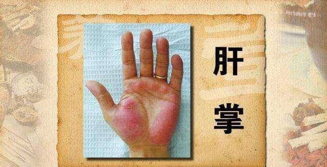 肝毒堆積過深，身體會發出這5個信號，1種野草根幫你排肝毒，護肝臟