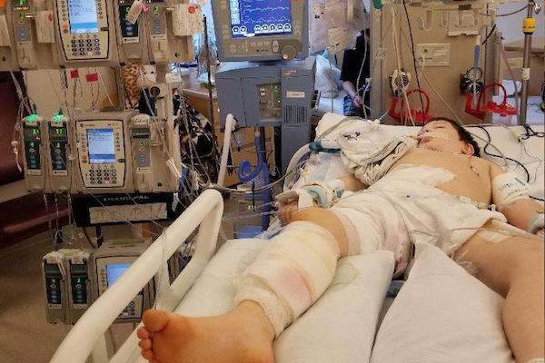 8歲男童騎腳踏車摔倒「縫了傷口」　但8天後「傷口反噬」把他右半邊身體都吃掉了 