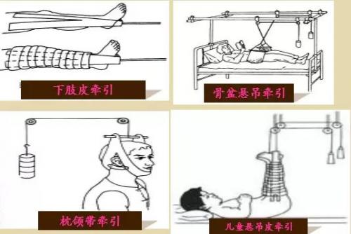 腰間盤突出煩惱大？看看這4種解決方法，總有1種適合你！
