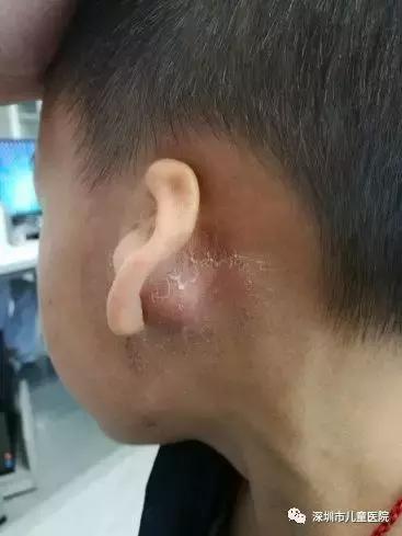 5歲男孩感冒發燒後，右耳後鼓起了紅腫的小包！這是什麼？醫生：炎症繼續發展，可能危及生命！