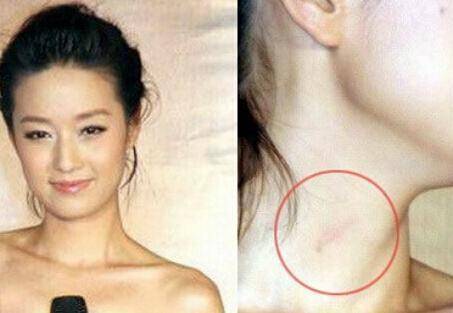 激情過度「留吻痕」的6位女星，而最後一個未婚也有？太尷尬…… -