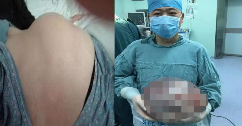 她未婚也無男友肚子卻大得出奇，到醫院檢查後醫生緊急幫她開刀，竟然在她肚子裡挖出了........太恐怖了！！ 