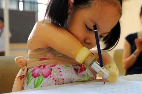懷孕7個月查出胎兒沒有手腳，孕媽不忍放棄，用愛和責任為殘疾女兒插上翅膀