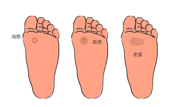 雞眼怎麼根治？這個偏方很有效