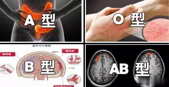 研究：Ｏ型易「中風」，Ａ型多「便秘」！四大血型「疾病風險」，一秒看懂血液危機！
