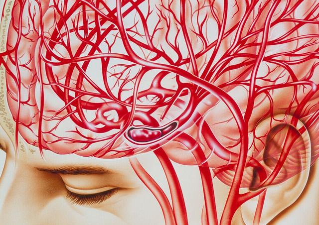 醫生告誡：「中風」病發前有五個前兆，早知道或許能保命！