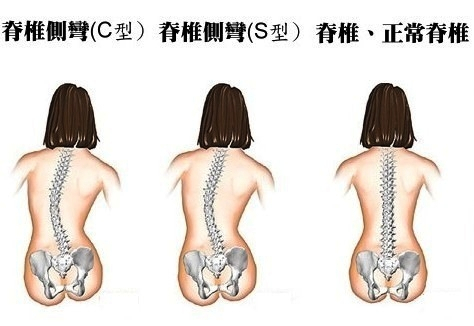 脊椎不好很痛苦，終於找到免錢的矯正脊椎方法了！