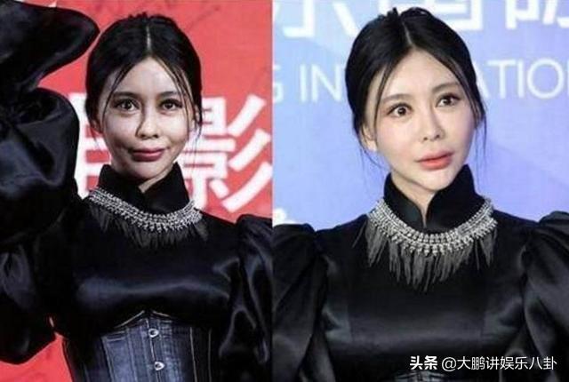 這些被「玻尿酸」毀掉的女星，看完你還敢打嗎？
