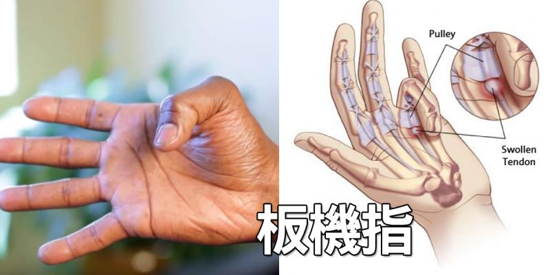 「板機指」發作手指僵硬動不了？兩分鐘「手指按摩」打通經脈，根治發炎免開刀！ 